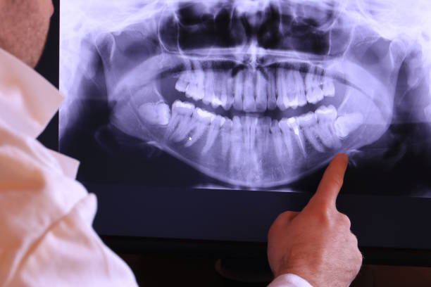 Best Emergency Wisdom Teeth Removal in Kensington, NY